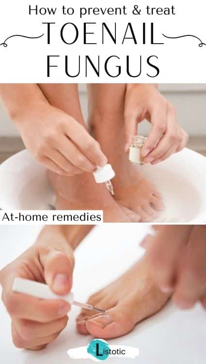 How to prevent toenail fungus.