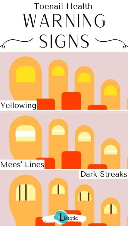 Nail health warning signs.